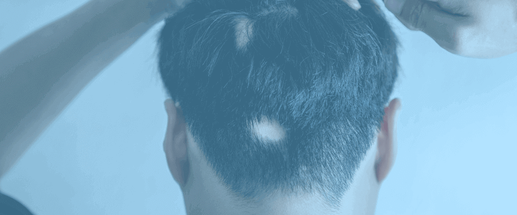 alopecia areata trpěliví
