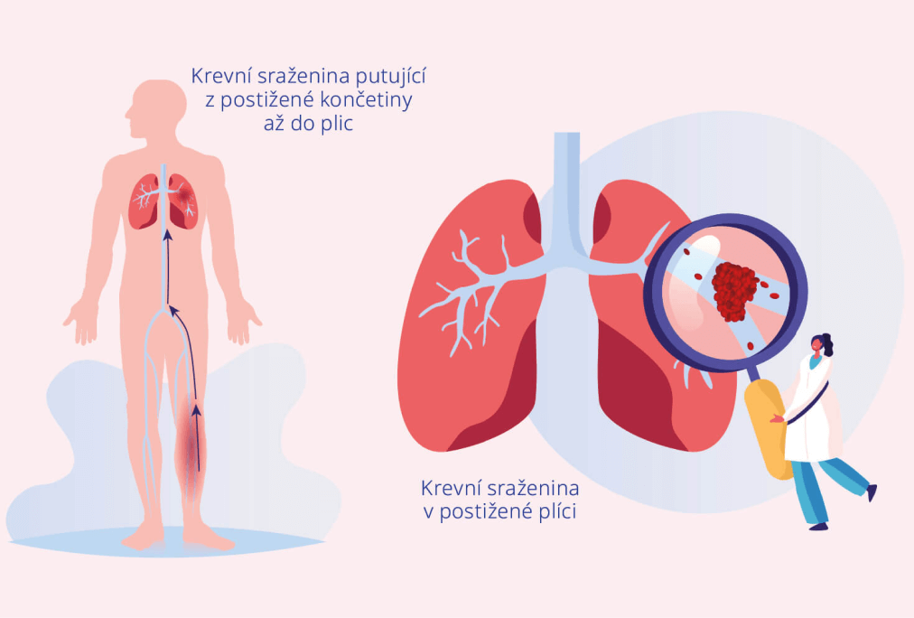 obrázek plicní embolie
