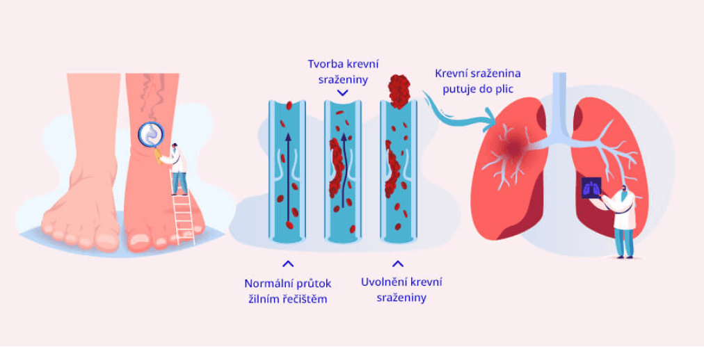 infografika o trombóze